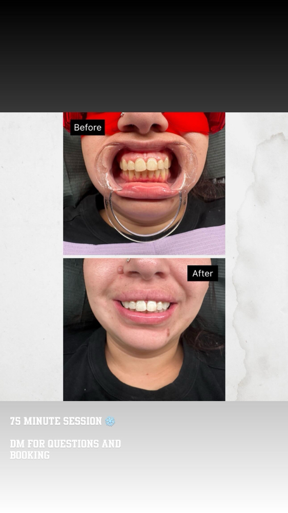 45 Minute Teeth Whitening