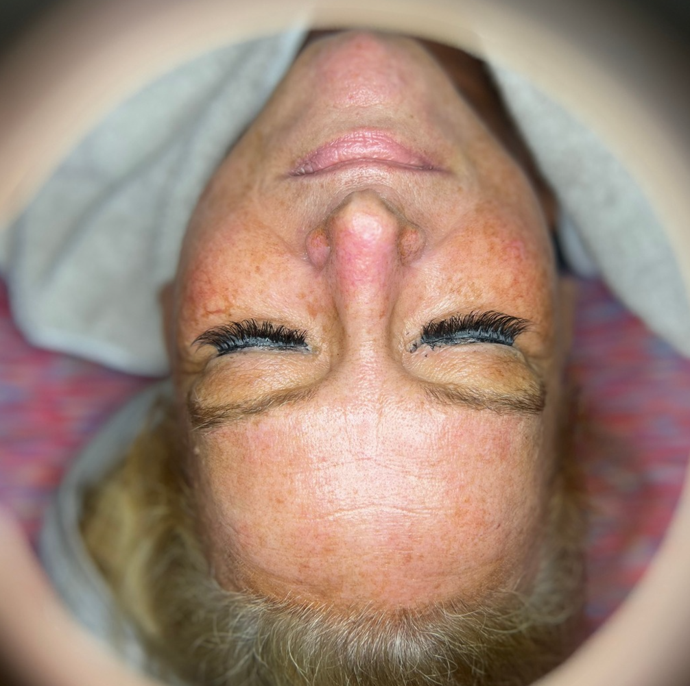 HydraFacial