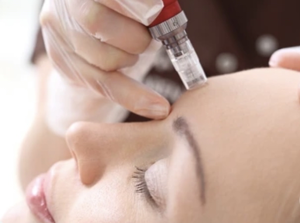 Microneedling