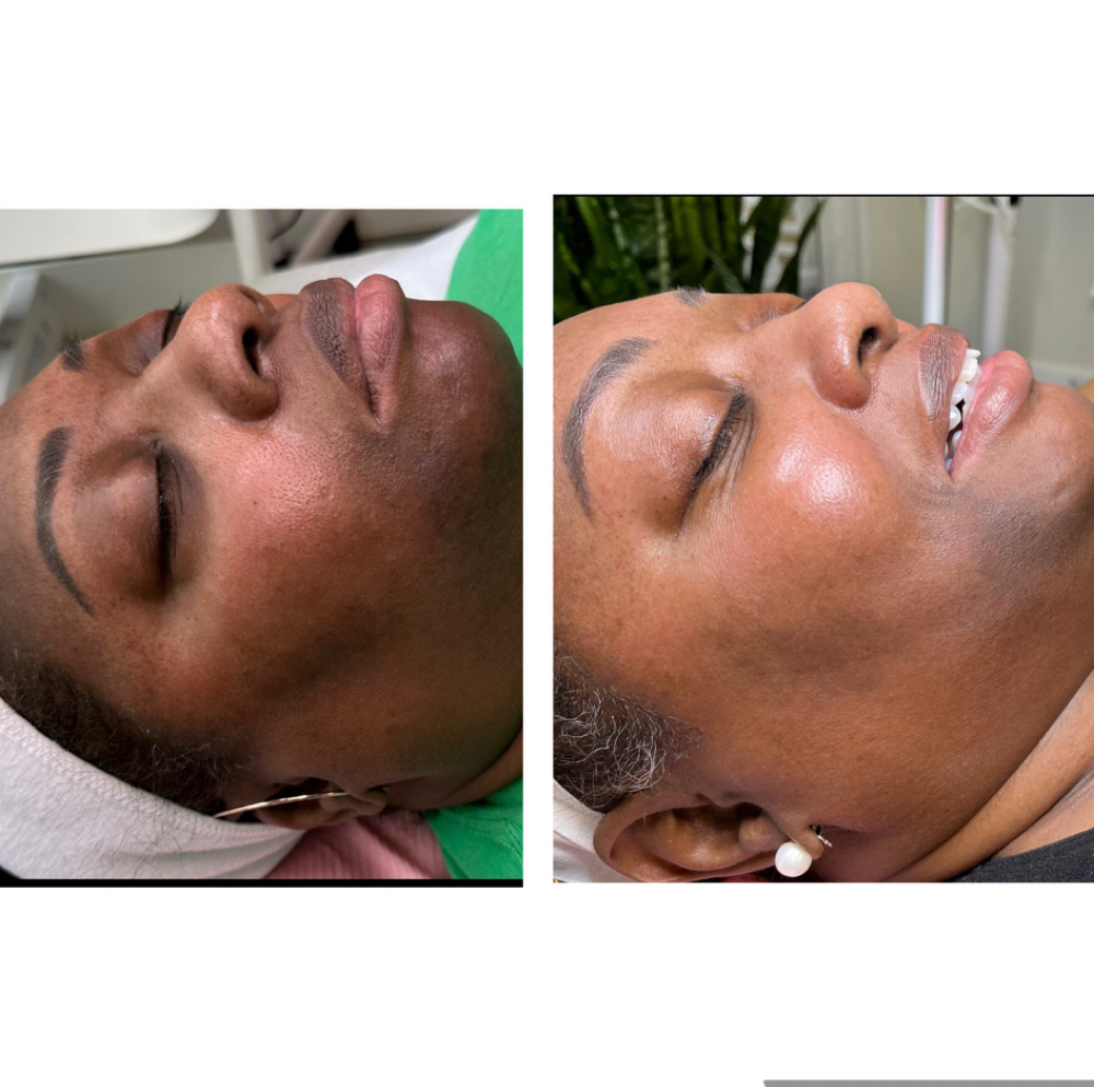 6- Session Corrective Program at Rêvelite Aesthetics in Temecula, CA