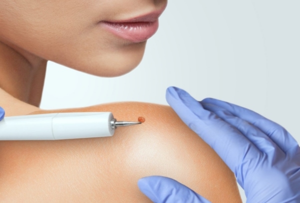 Skin Tag Removal