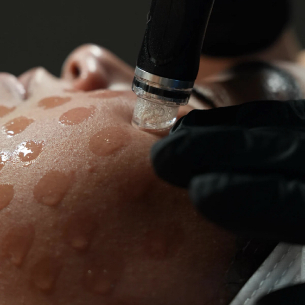 Hydro-Dermabrasion Facial at DURALOUNGE in Redlands, CA