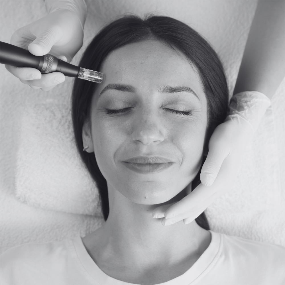 RF Microneedling – Large Area at Kietre Wellness & Aesthetics in North Las Vegas, NV