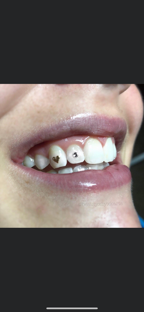 Tooth Gems-Diamond💎