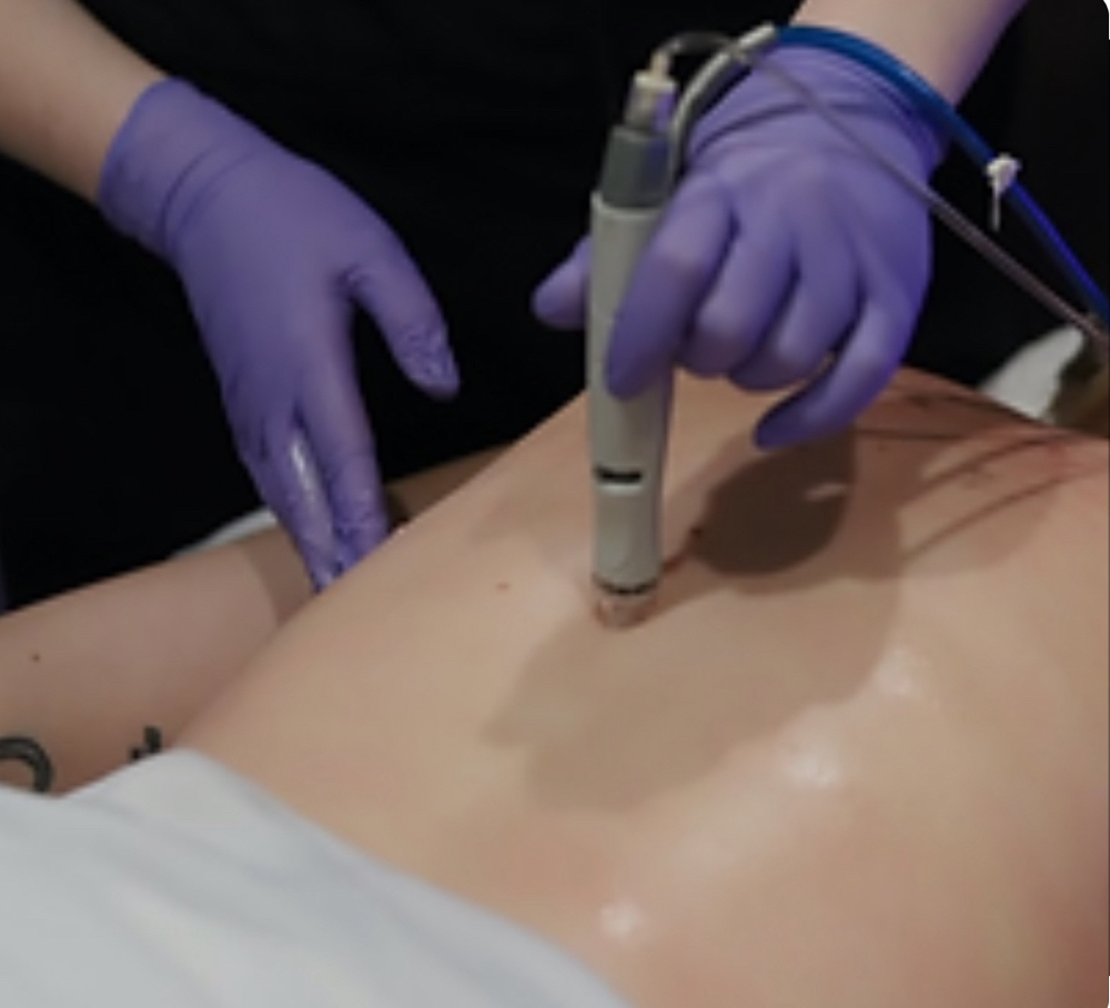 Hydrodermabrasion Back Treatment