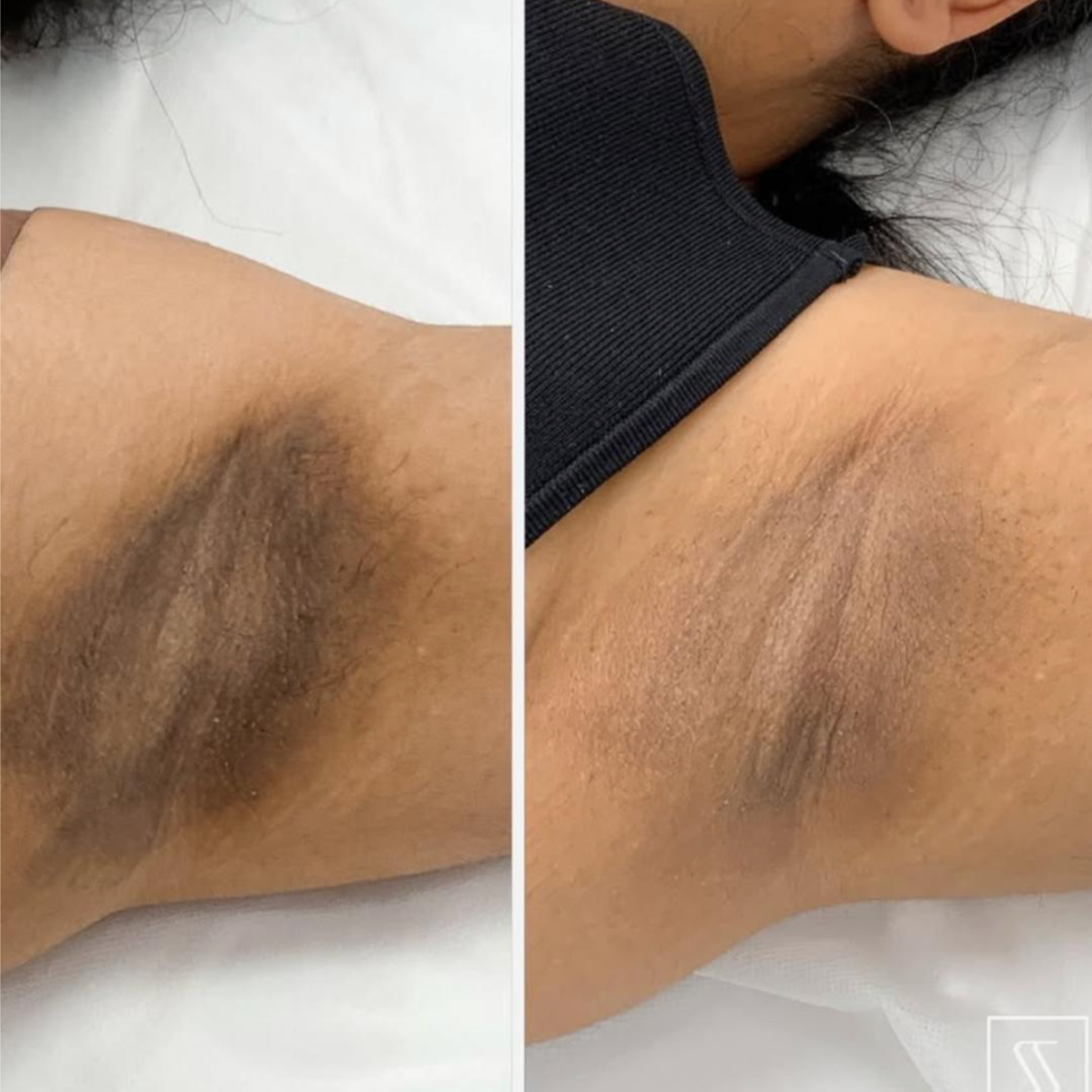 Underarm Correction at Skin 4 Glow Inc in MOHEGAN LAKE, NY