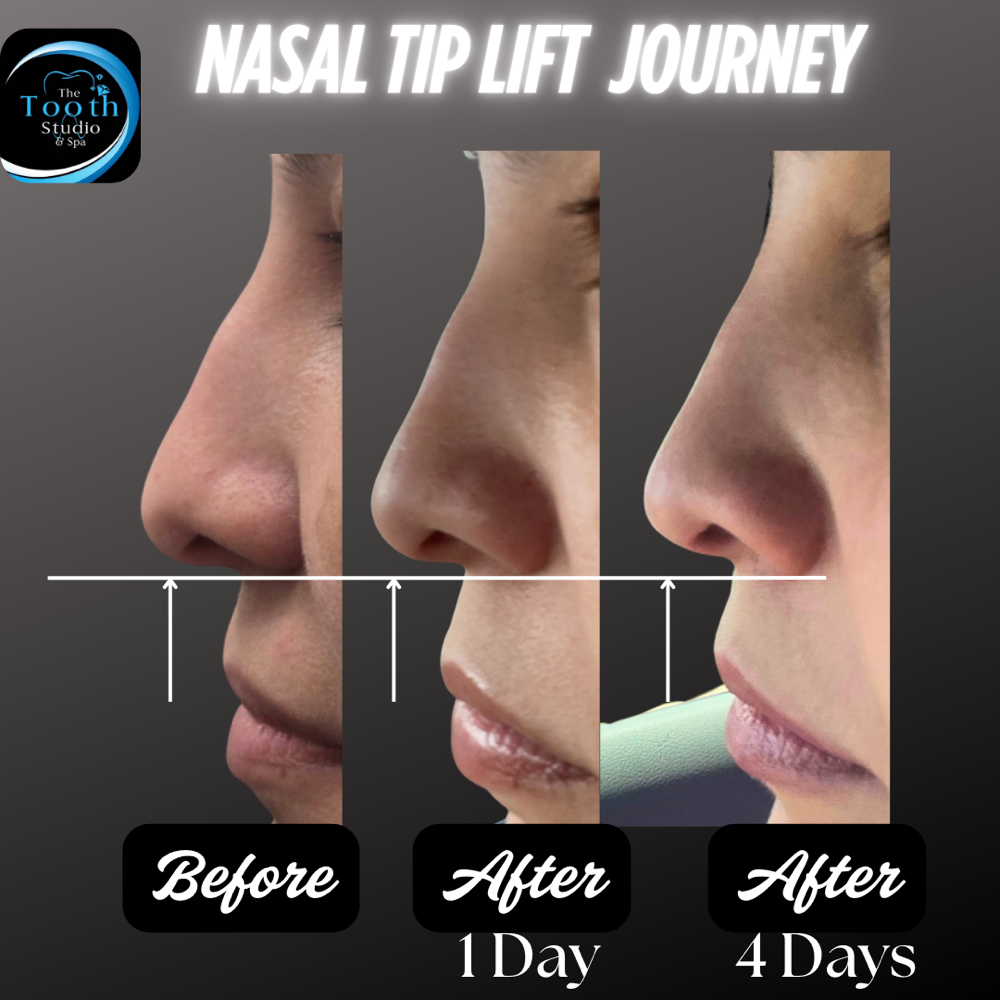 Nose Tip Lift W/Tox