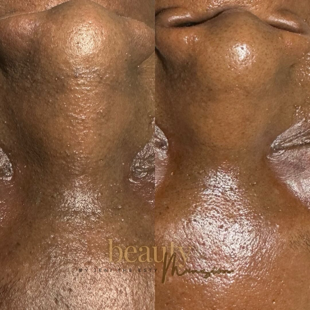 Hard Reset Facial