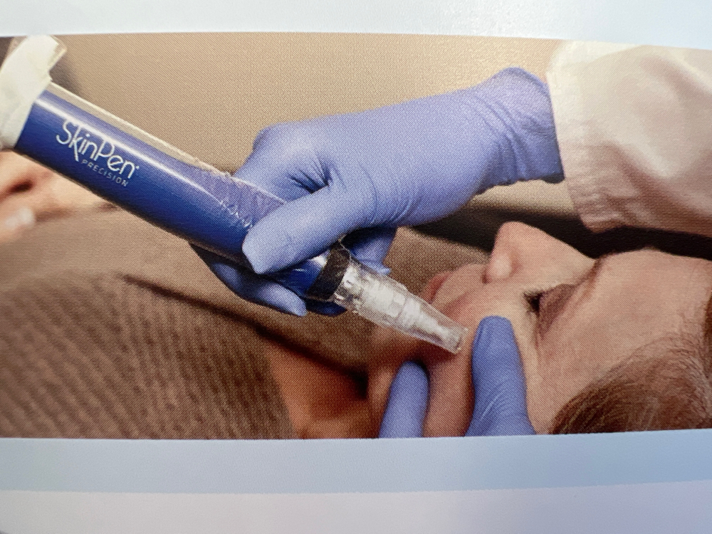 Microneedling + PRP / SkinPen