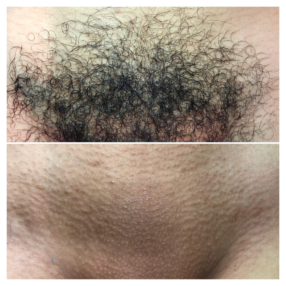 Brazilian Wax