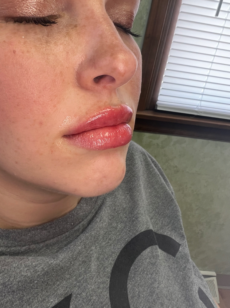 FULL SYRINGE/ LIP FILLER