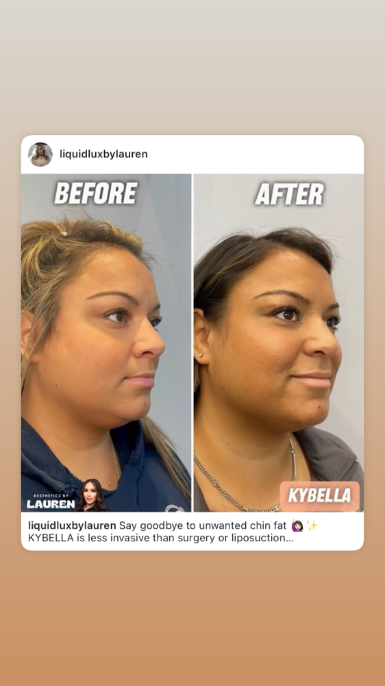 FDA Apvd Fat Dissolving Injections