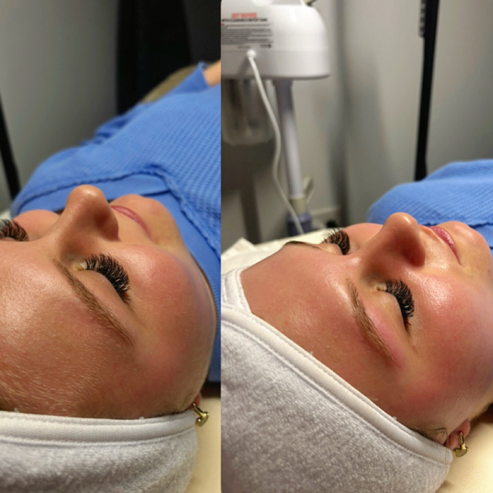 Dermaplane Facial at Blair’s Skincare in Bowling Green, KY