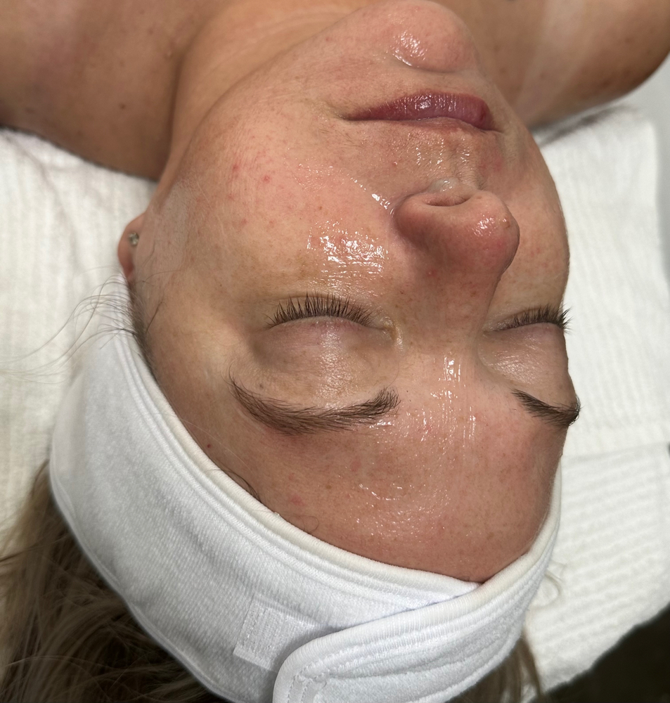 HydraFacial