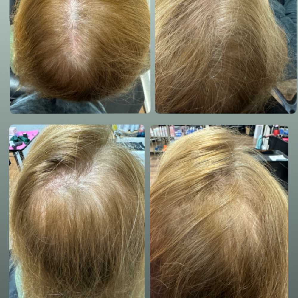 Procell Hair Restoration at Sam Elam Esthetics in Meridian, ID