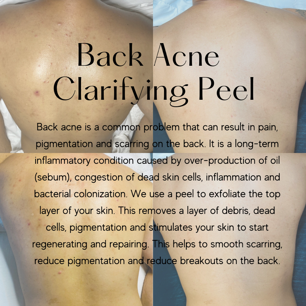 Back Acne Clarifying Peel