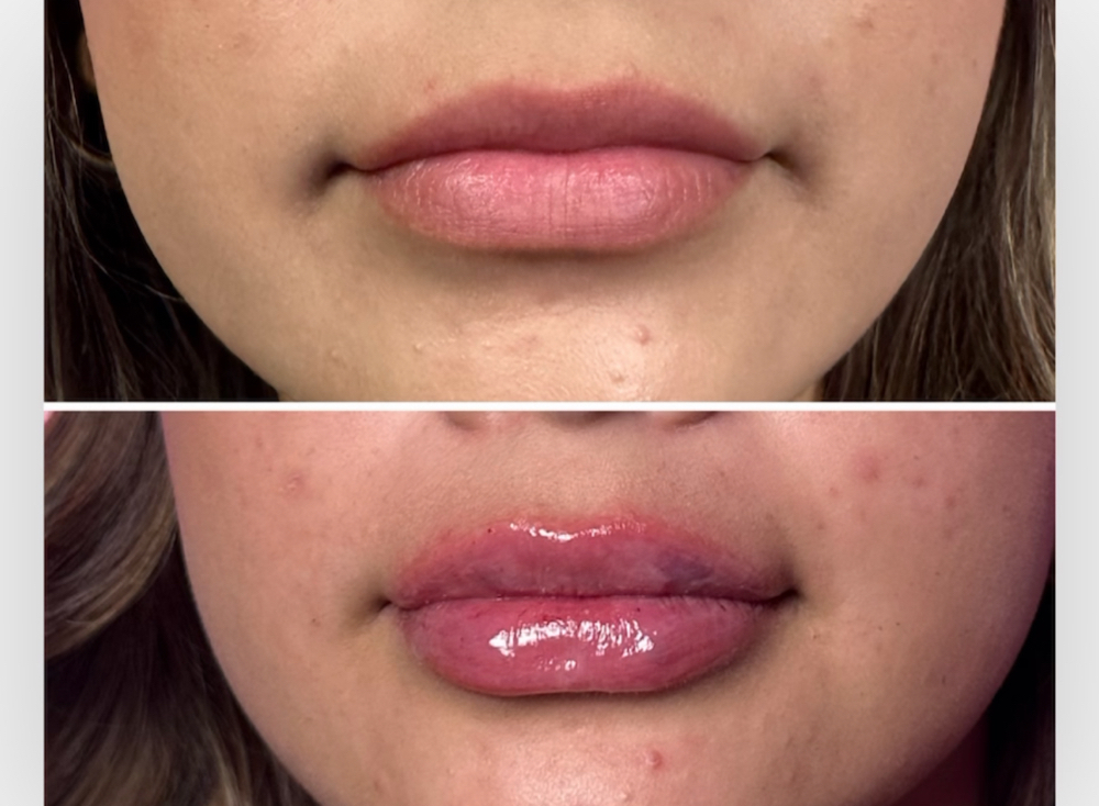 Lip Filler: Mini Lip Plump ✨