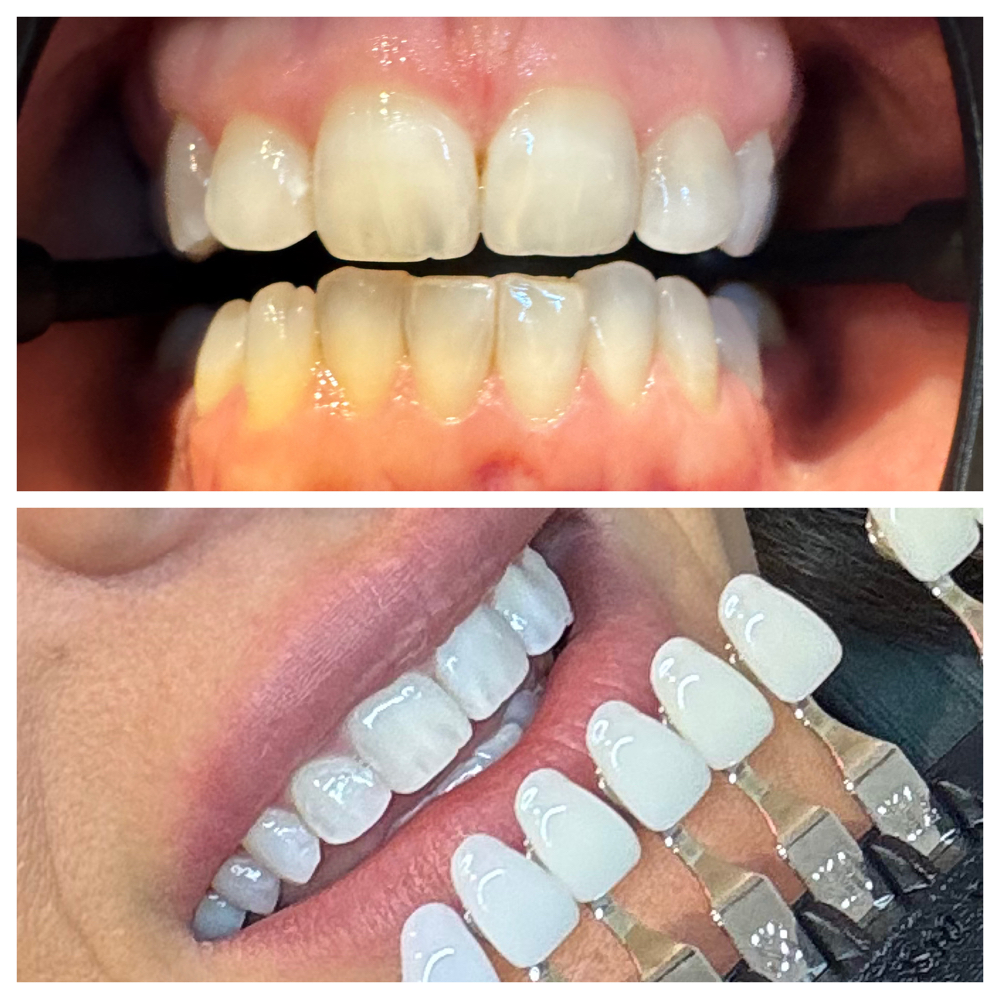 Teeth Whitening March Special 20% off