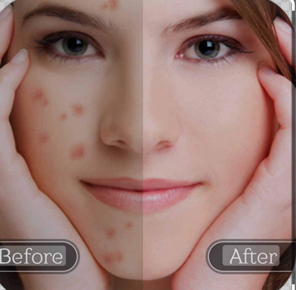 Tratamento De Acne (Avaliação)