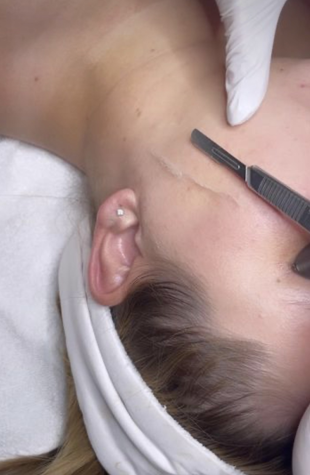 Dermaplane