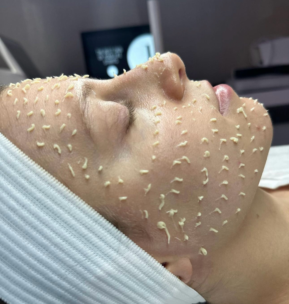 CellStory Liquid Microneedling