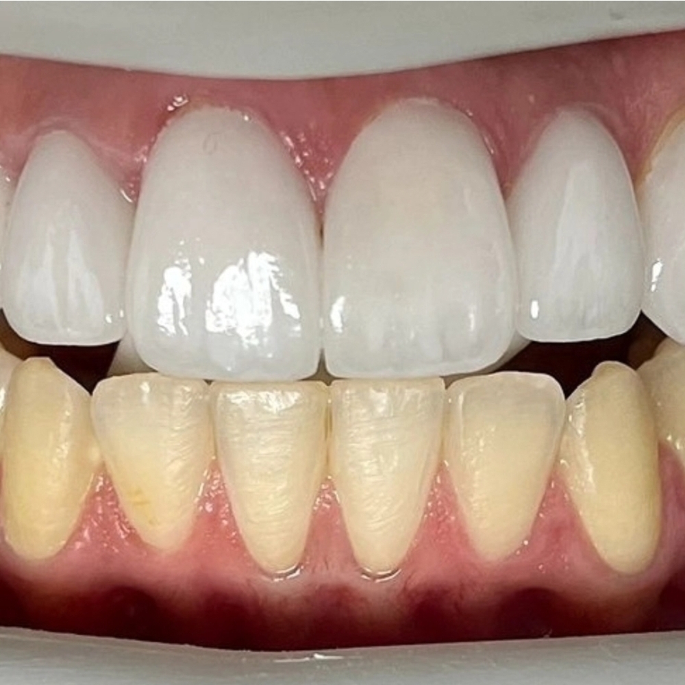 Ultimate Sparkle Whitening Session at Sparkle and Shine Beauty in Lincoln, RI