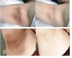 Dark Spot Correction