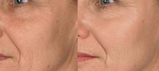 Anti Aging Facial
