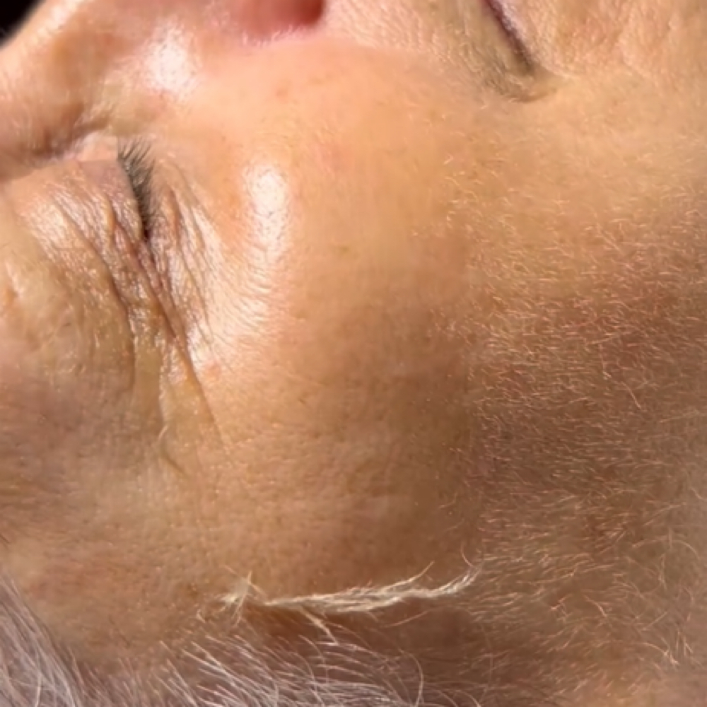 Dermaplane Treatment at Peyton Bustamante in Harrisburg, IL