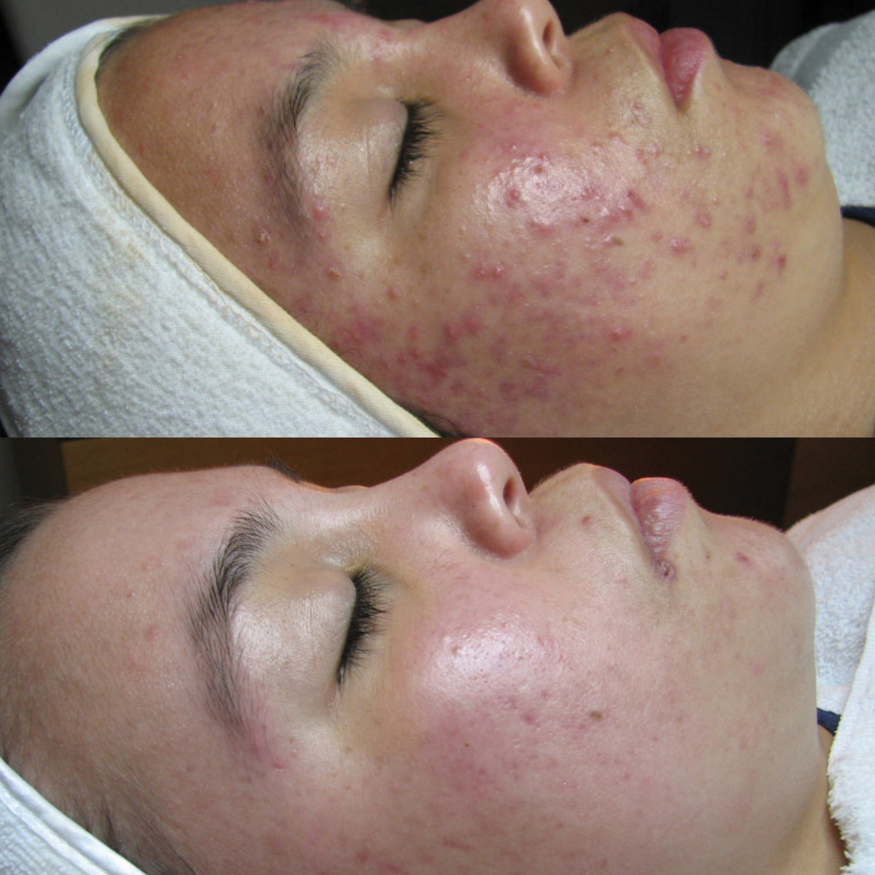Face Reality Acne Bootcamp** at Skin & Beauty Aesthetics Studio in New York, NY