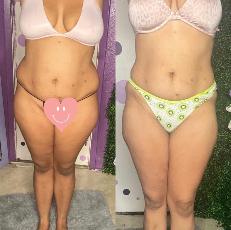 Skin Tightening 30min