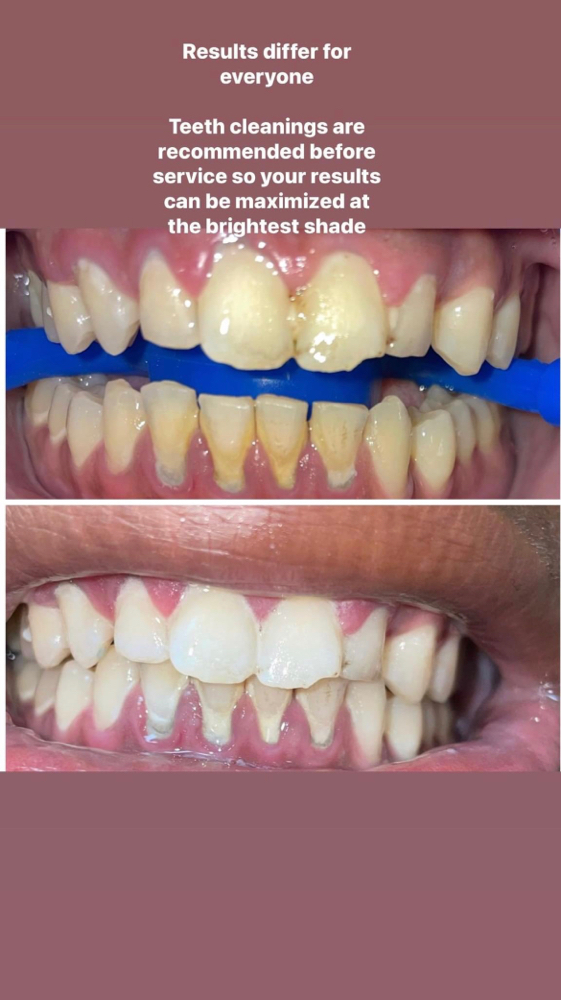 Cosmetic Teeth Whitening 60 Minutes