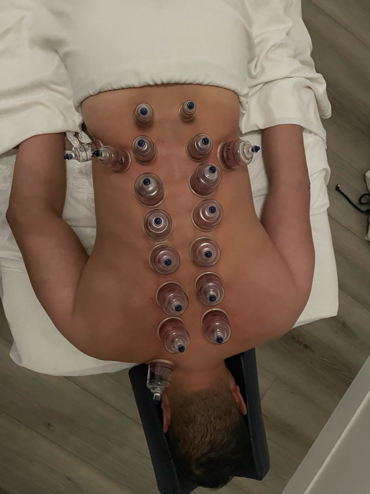 Add-on: Cupping