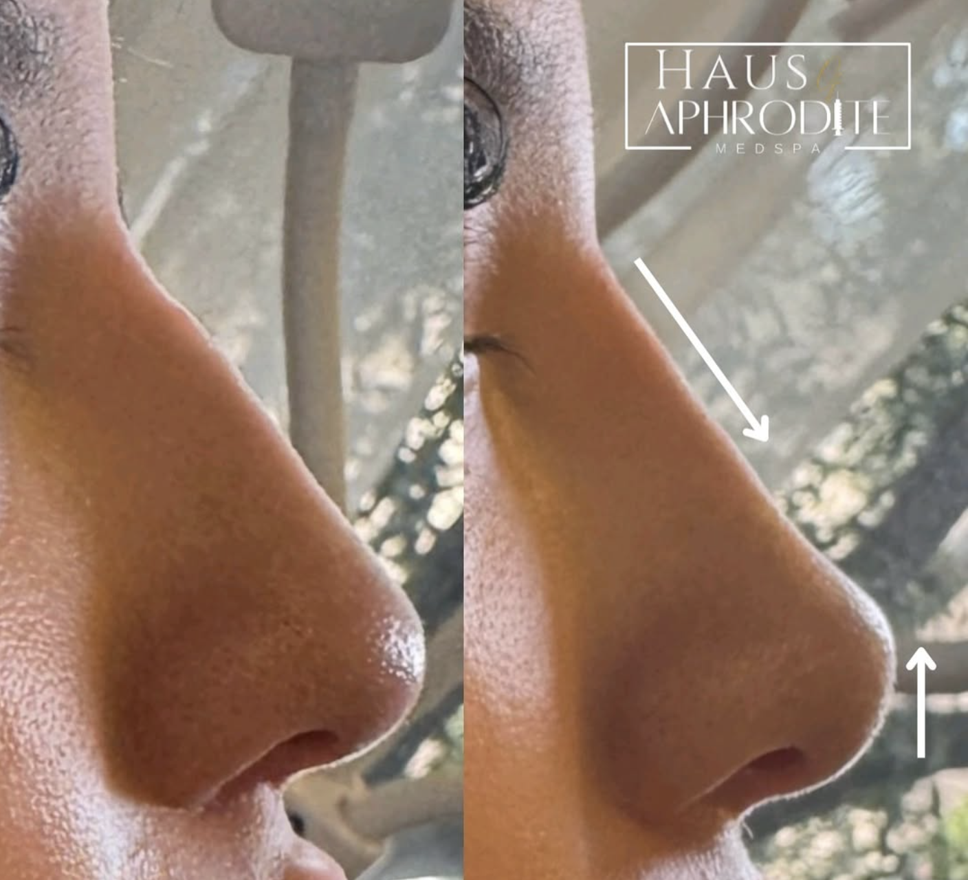 Non-Surgical Rhinoplasty