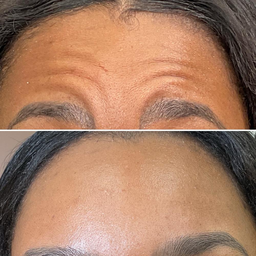 Botox, Letybo, Xeomin, Daxxify at Agoddess Spa & Wellness in DeSoto, TX