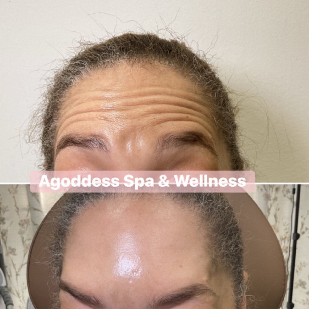 Botox, Xeomin, Daxxify at Agoddess Spa & Wellness in DeSoto, TX