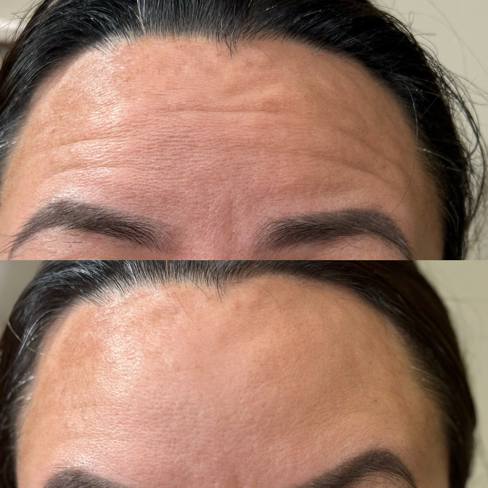 Botox, Letybo, Xeomin
