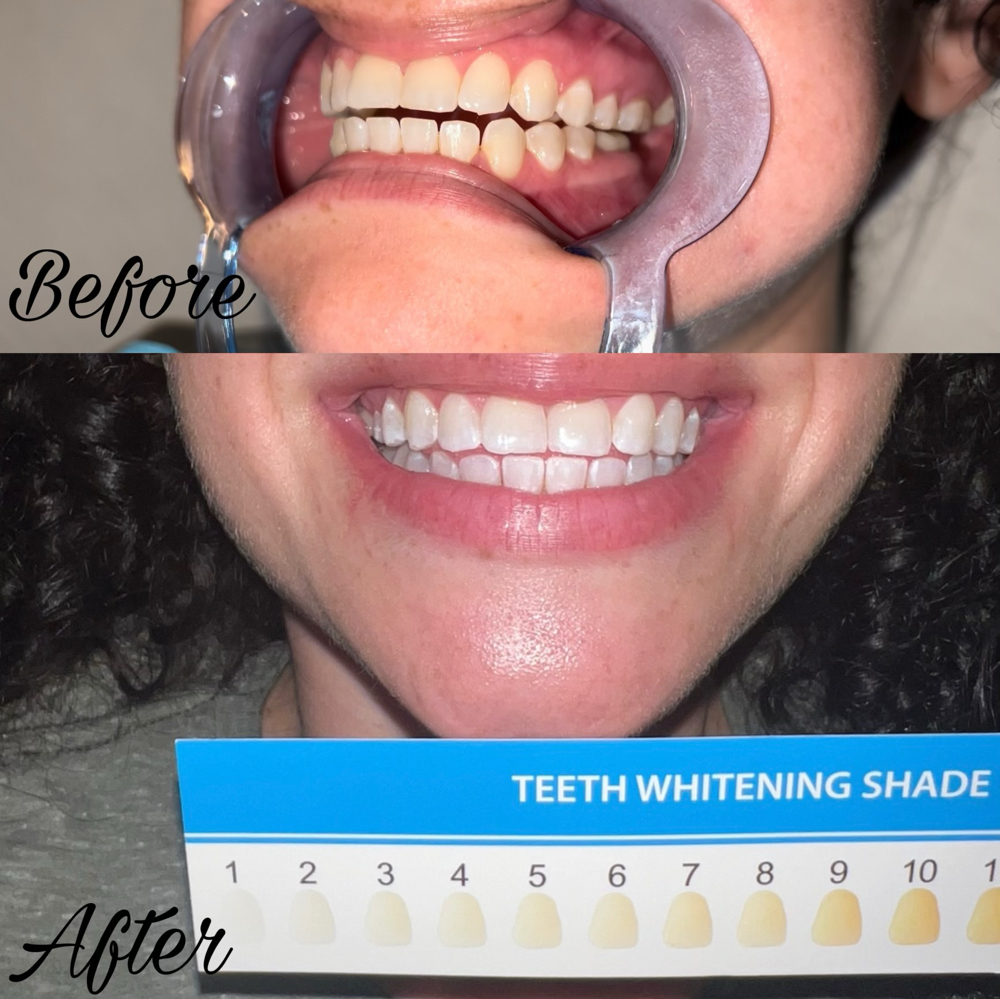 Teeth Whitening (1 hour)