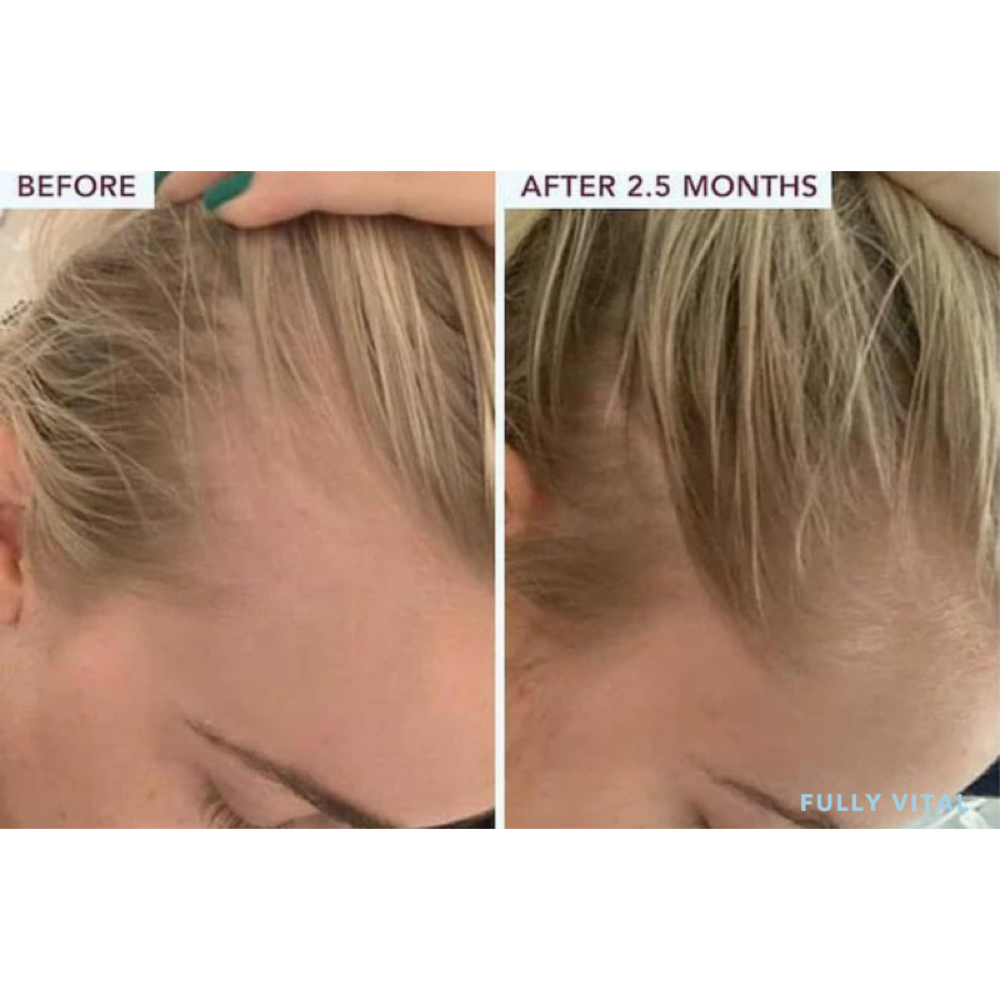 Scalp Renewal Therapy at PureBeauty-Aesthetics in Colorado Springs, CO