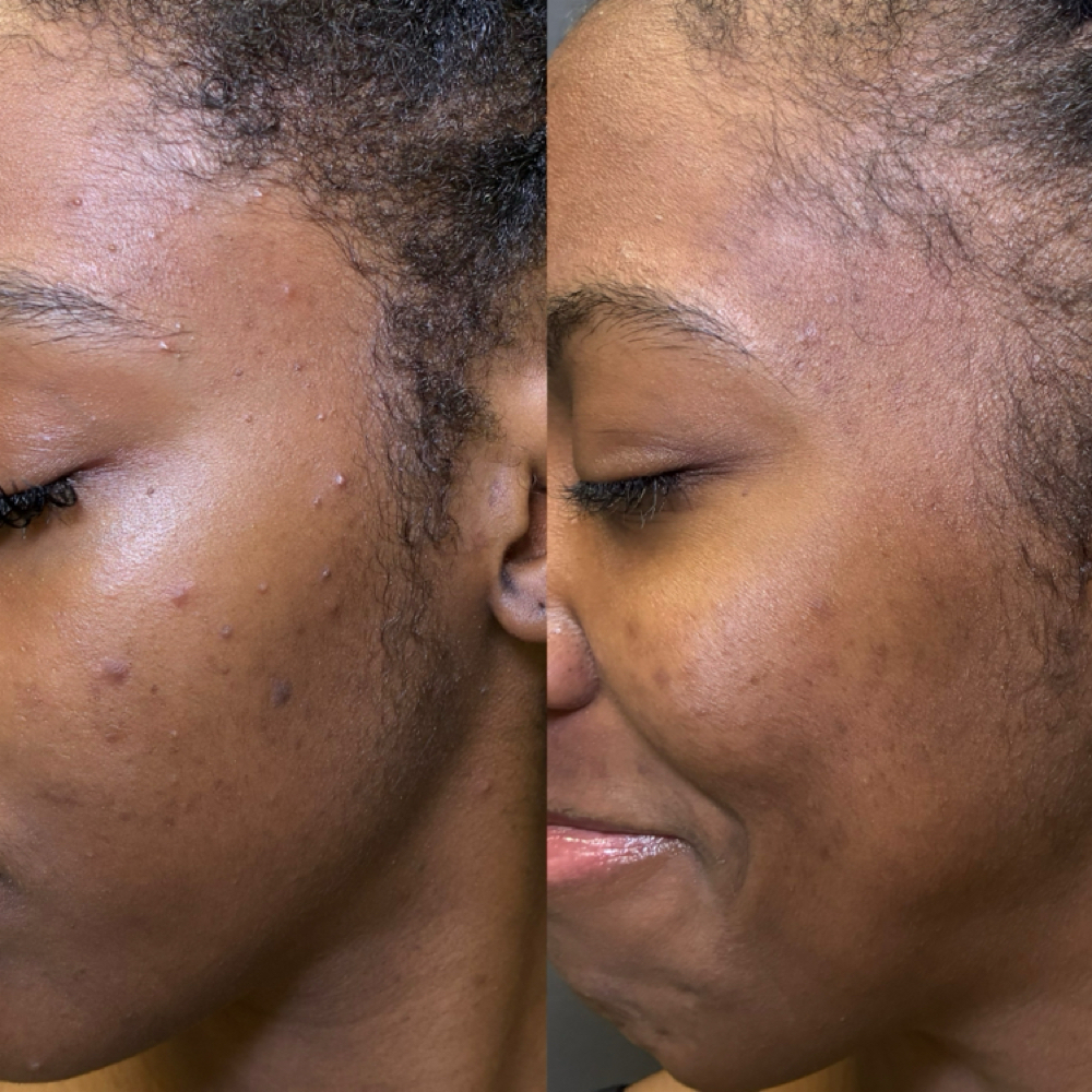Pigment Correct Peel at Oasiah Aesthetics in New York, NY