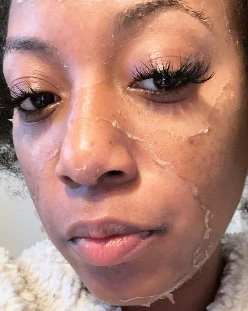 CHEMICAL PEEL