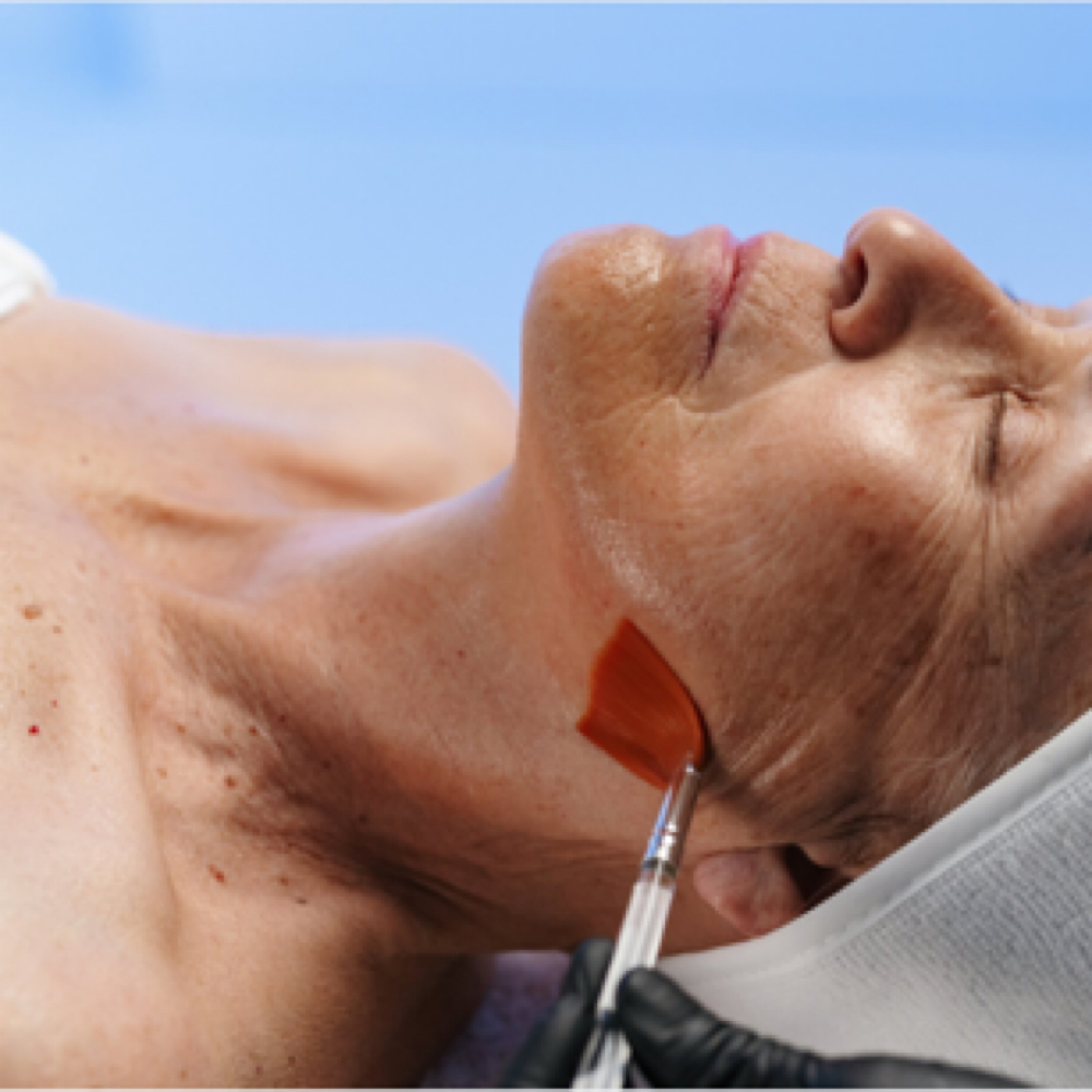 SWiCH (Chemical Peel Alternative)