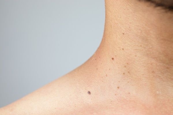 Fibroblast Skin Tag Removal