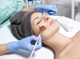 Chemical Peel Only