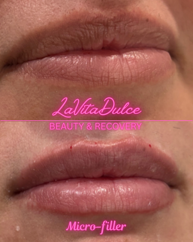 Micro Lip Filler