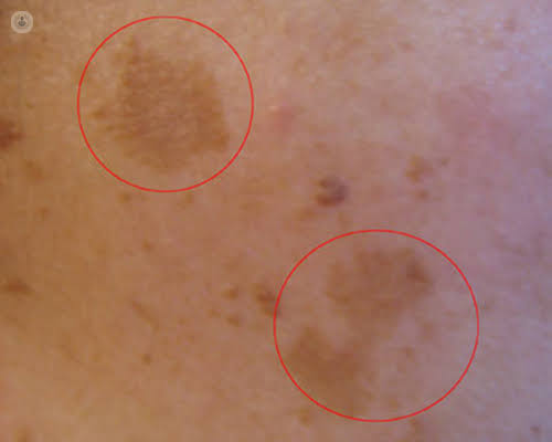 Pigment Lesion Removal