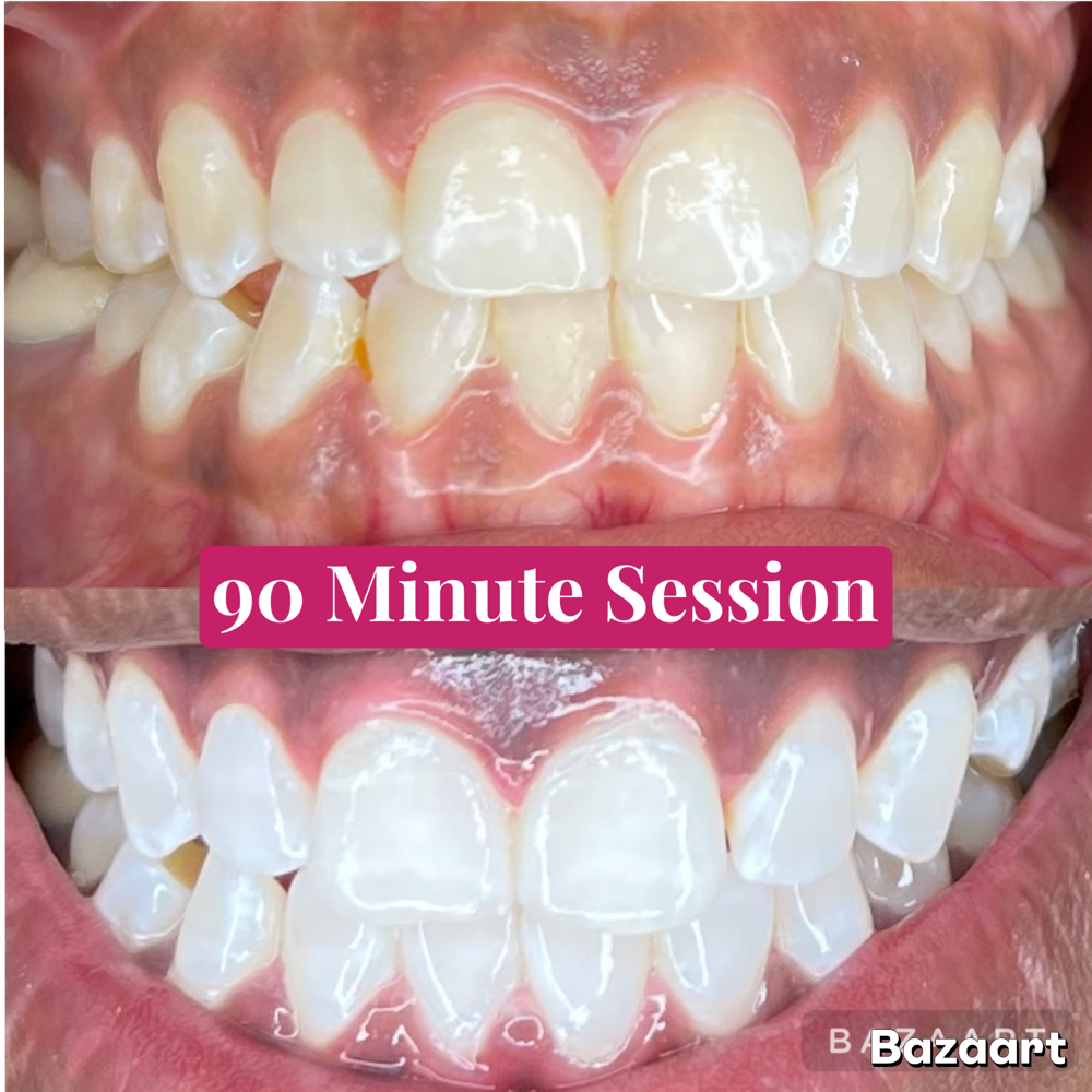 90 Minute Whitening