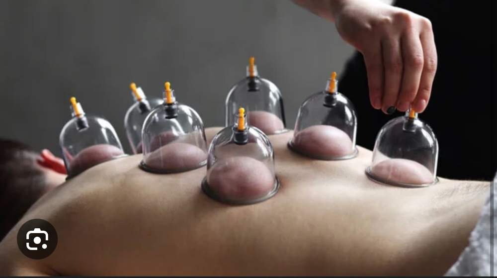 Cupping Therapy