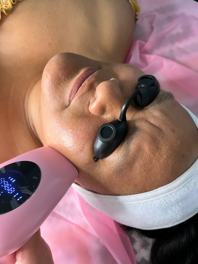 Full Face Laser Hair Removal 10 Ses
