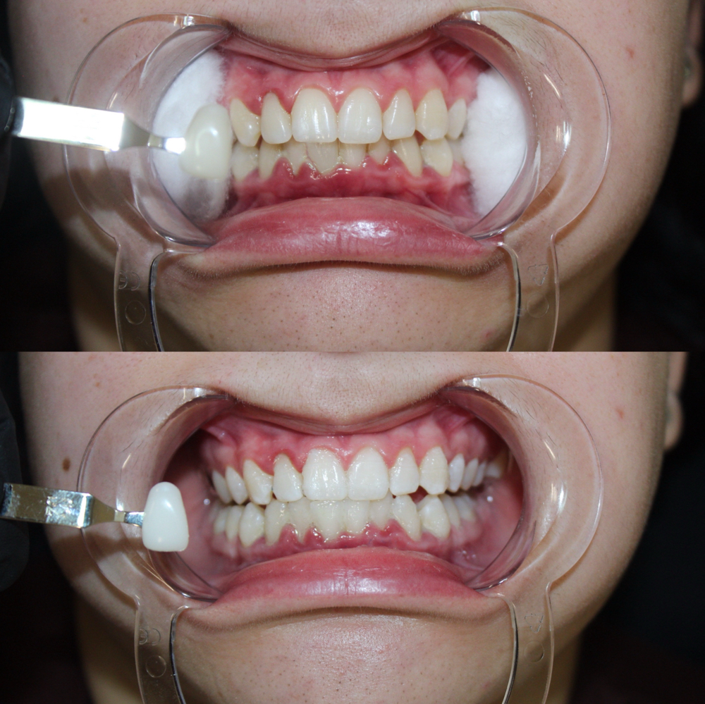 Teeth Whitening (1 Hour)